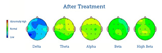 Brain maps showing delta, theta, alpha, beta, and high beta brainwave activity after treatment, with mostly normal activity levels indicated by green regions