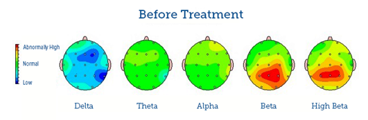 Brain maps showing delta, theta, alpha, beta, and high beta brainwave activity before treatment, with colour-coded regions indicating high, normal, and low activity levels